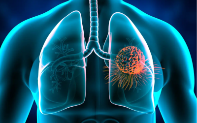 Women Under 50 Are More Likely to Have Lung Cancer Than Men: Study